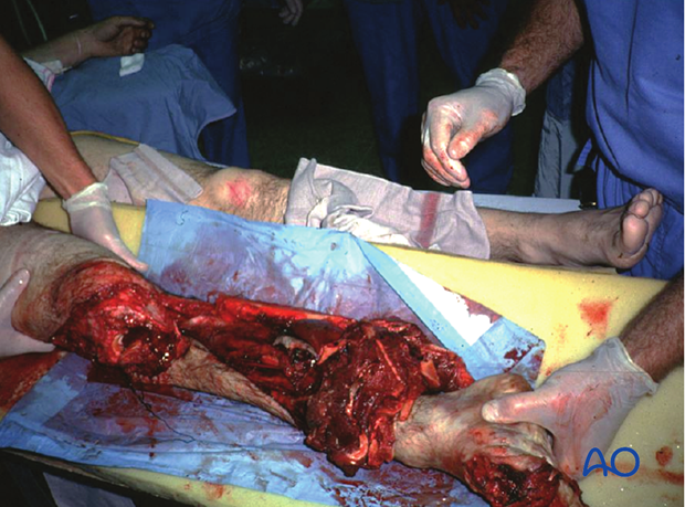A mangled extremity is a life-threatening injury. Some extremity injuries are so severe that amputation is a safer ...
