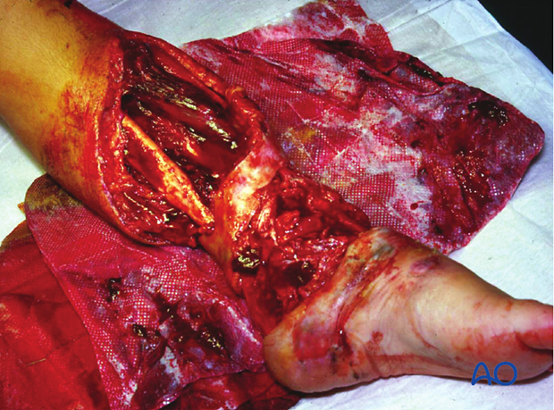Open fractures need prompt diagnosis, appropriate intravenous antibiotics, meticulous injury...