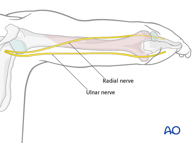 For midshaft and distal shaft fractures, the posterior approach may be extended distally, leaving the triceps insertion intact.