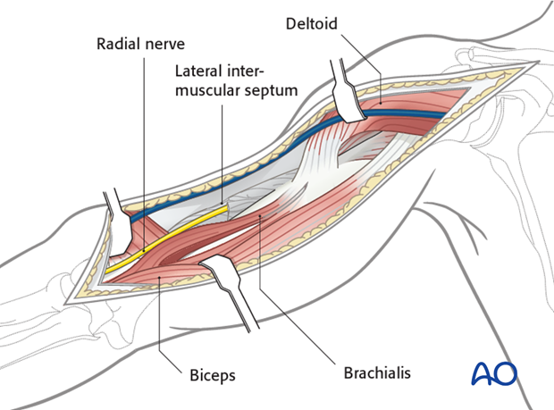 Dissect the brachialis within the neurovascular plane between the radial and the musculocutaneous nerves to maintain innervation of the brachialis.
