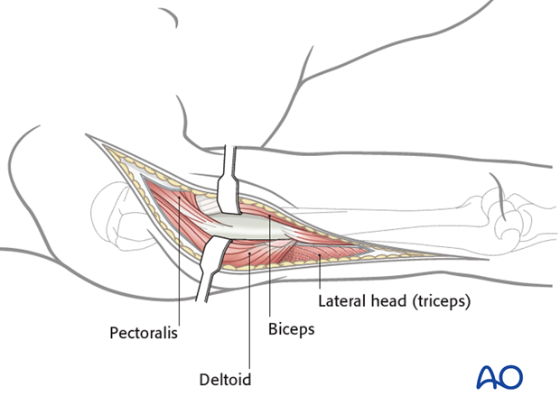Proximal extension of the approach