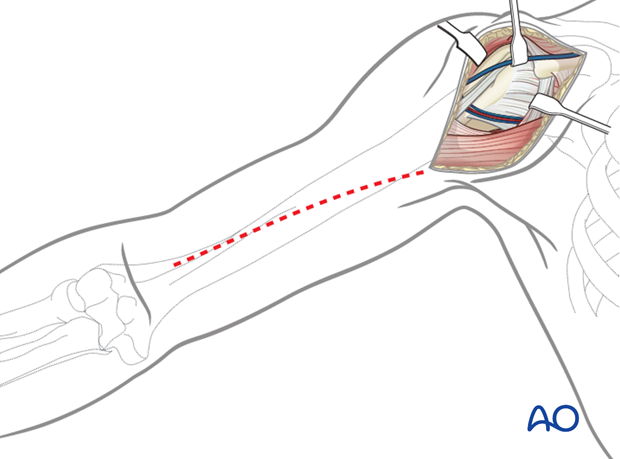 Extended deltopectoral approach to the humeral shaft