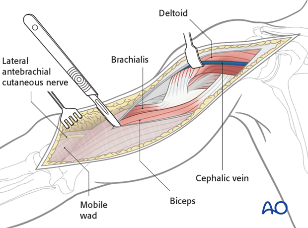Superficial dissection of the humeral shaft