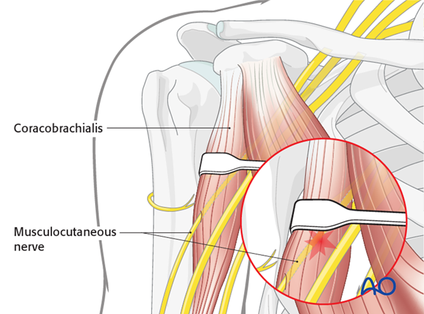 Pitfall: neurapraxia of musculocutaneous nerve