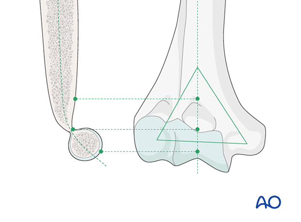 The articular block of the distal humerus is anteriorly angled by about 40° with respect to the humeral shaft axis.