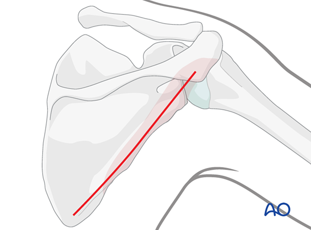 posterior approach to the scapular body