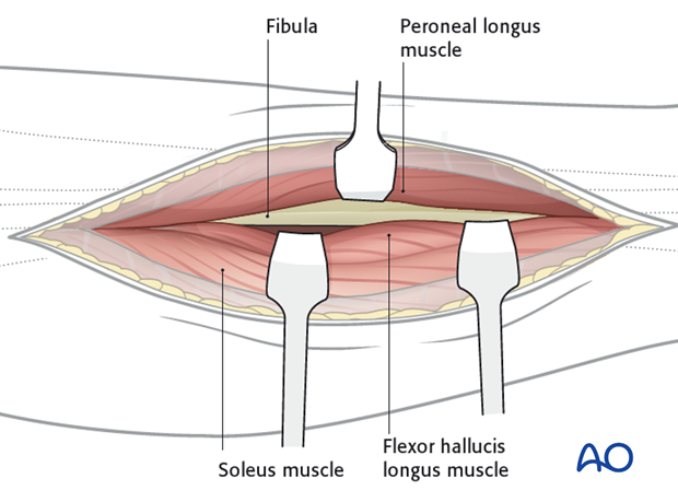 The fascia is incised and the gastrocnemius and soleus are mobilized medially leaving the peroneal muscles laterally.