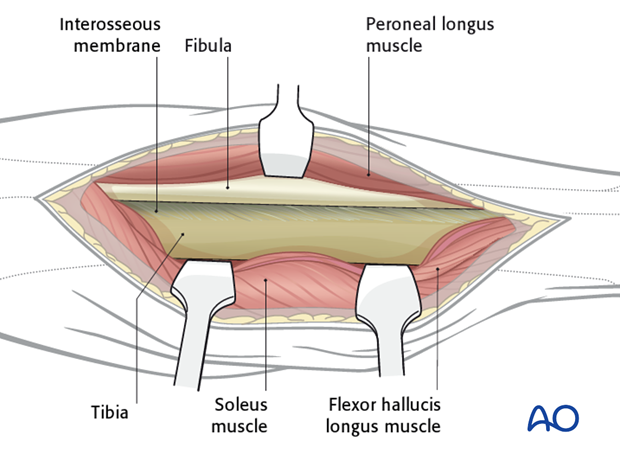 At the conclusion of the dissection the surgeon should have access to the posterior aspects of both the tibia and the fibula.