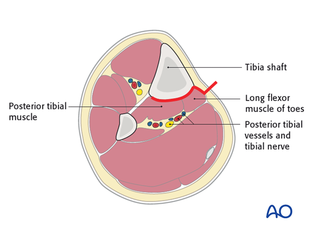 The posteromedial approach can be used for open plate fixation of the tibia on its posterior surface. 