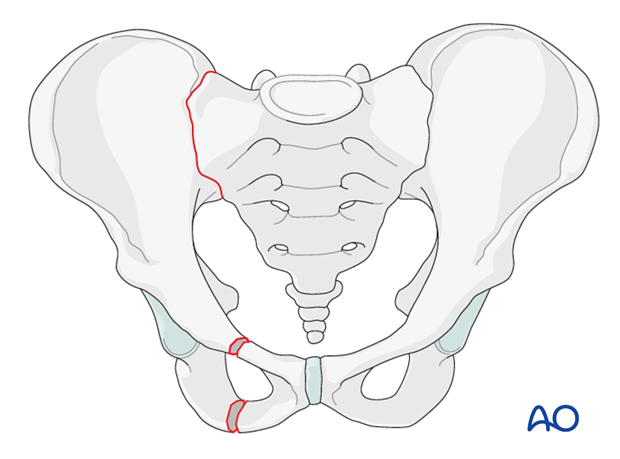 Pubic ramus fractures