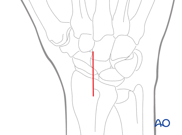 Proximal pole fractures