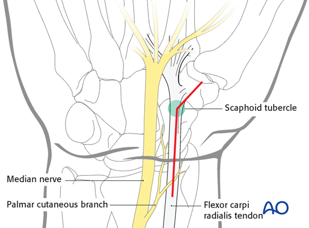 Palmar approach to the scaphoid - Indications