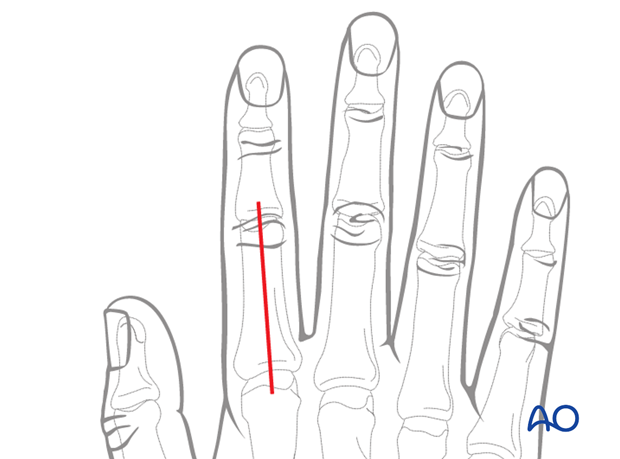 Dorsal approach to the phalangeal metaphysis (after Pratt)
