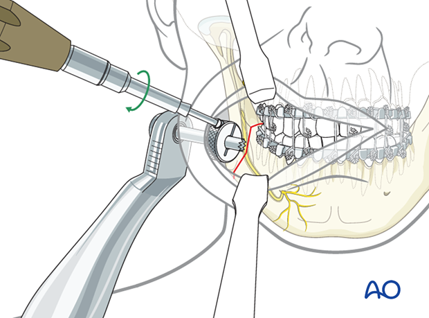 Use of ring retractor