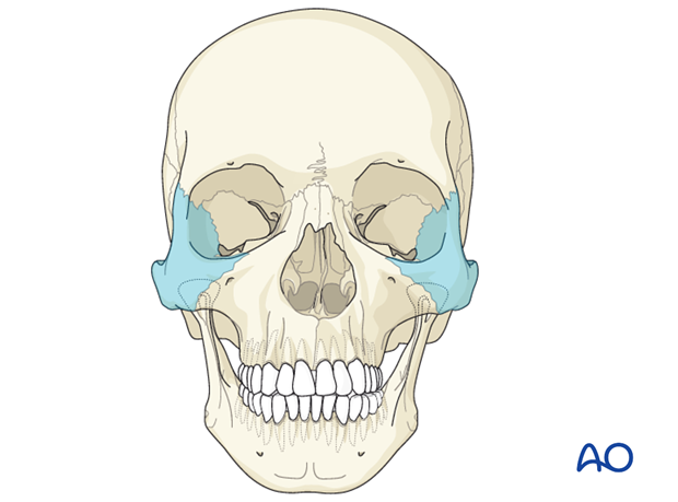 AOCMF Classification Midface (Level 1 and 2)
