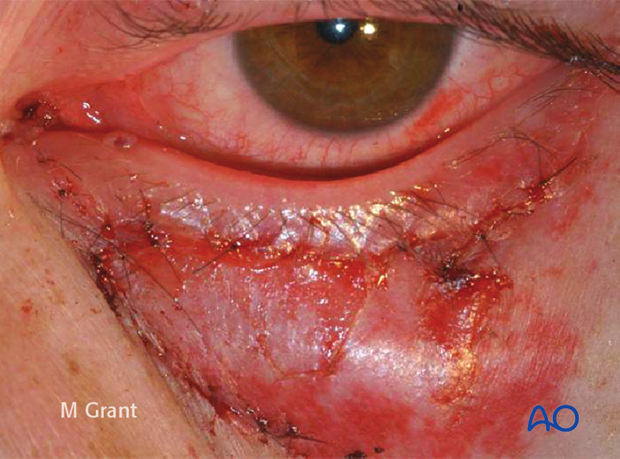Repair of periorbital soft-tissue injuries and lacrimal system in NOE injuries