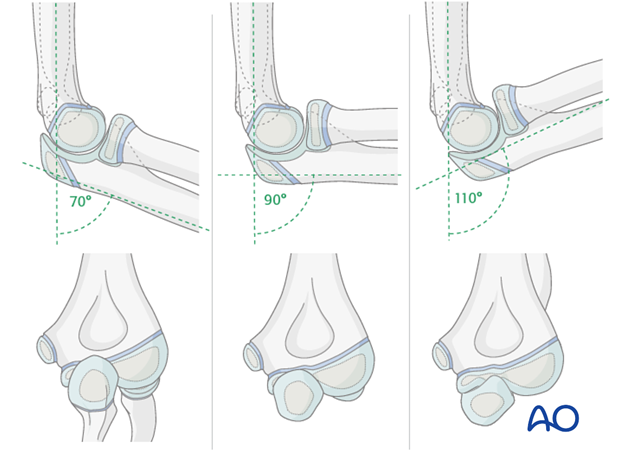 posterior approach without olecranon osteotomy