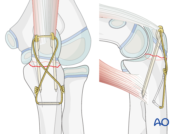 Mentaliteit Verborgen Oswald Open reduction; tension band fixation for 21u-M/3 - Ulna, complete