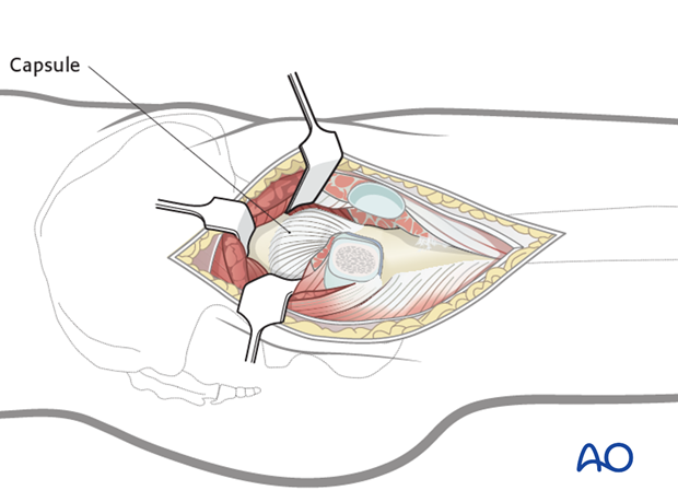 transgluteal approach