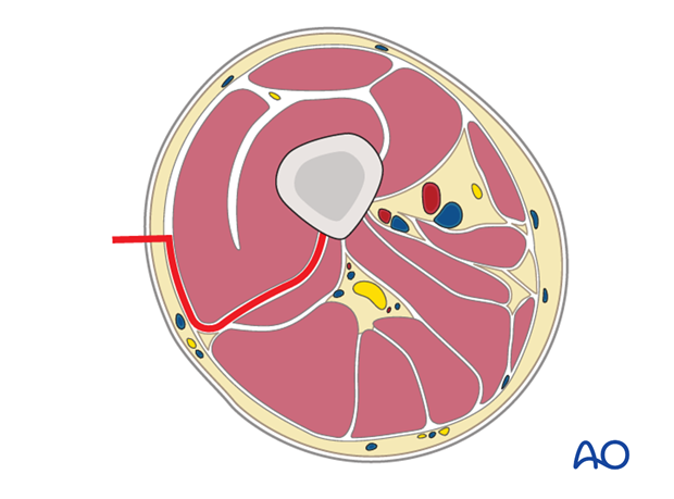 Cross-section of the thigh dissection path