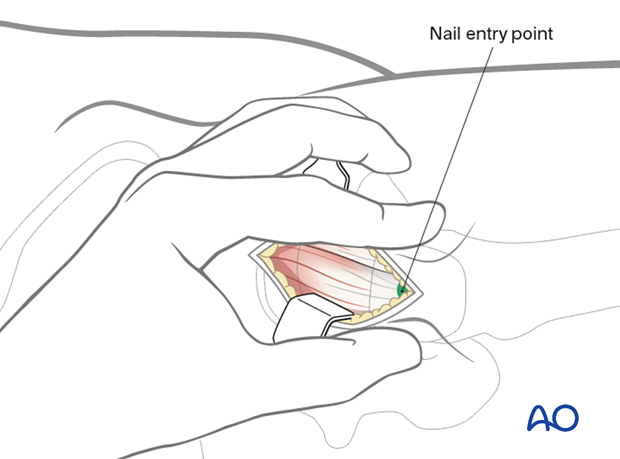 Position of nail entry point