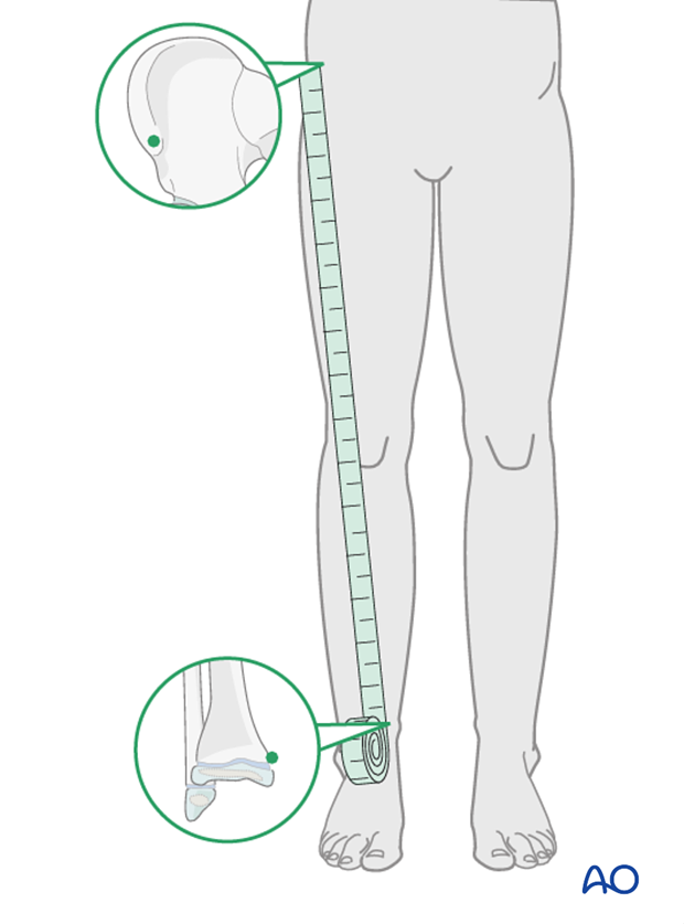 Clinical assessment of leg length with tape measure form ASIS to medial malleolus